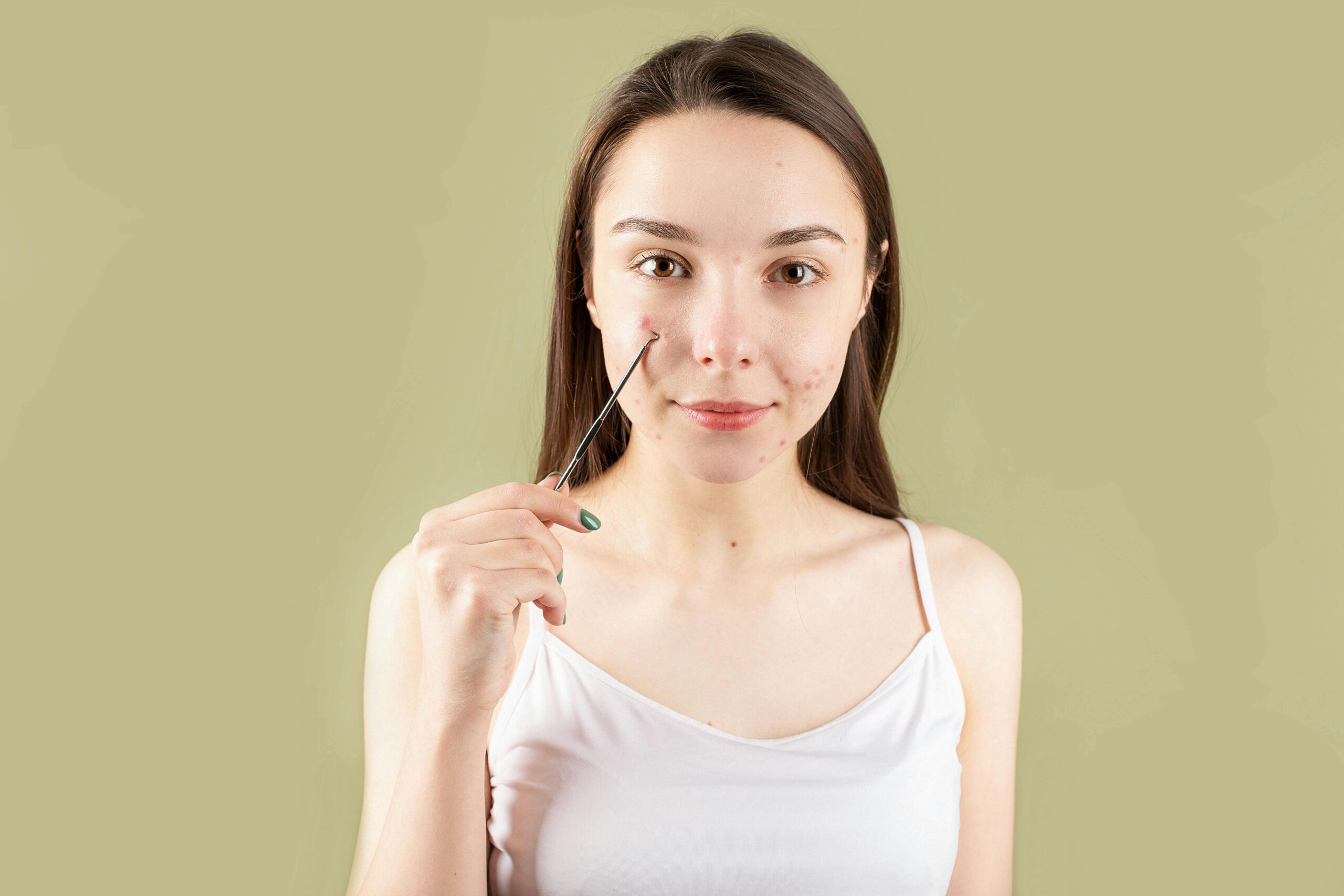 A beautiful young girl struggling with acne on her face