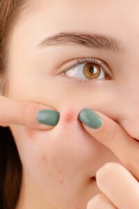 Read more about the article What is Fungal Acne and How to Treat It?