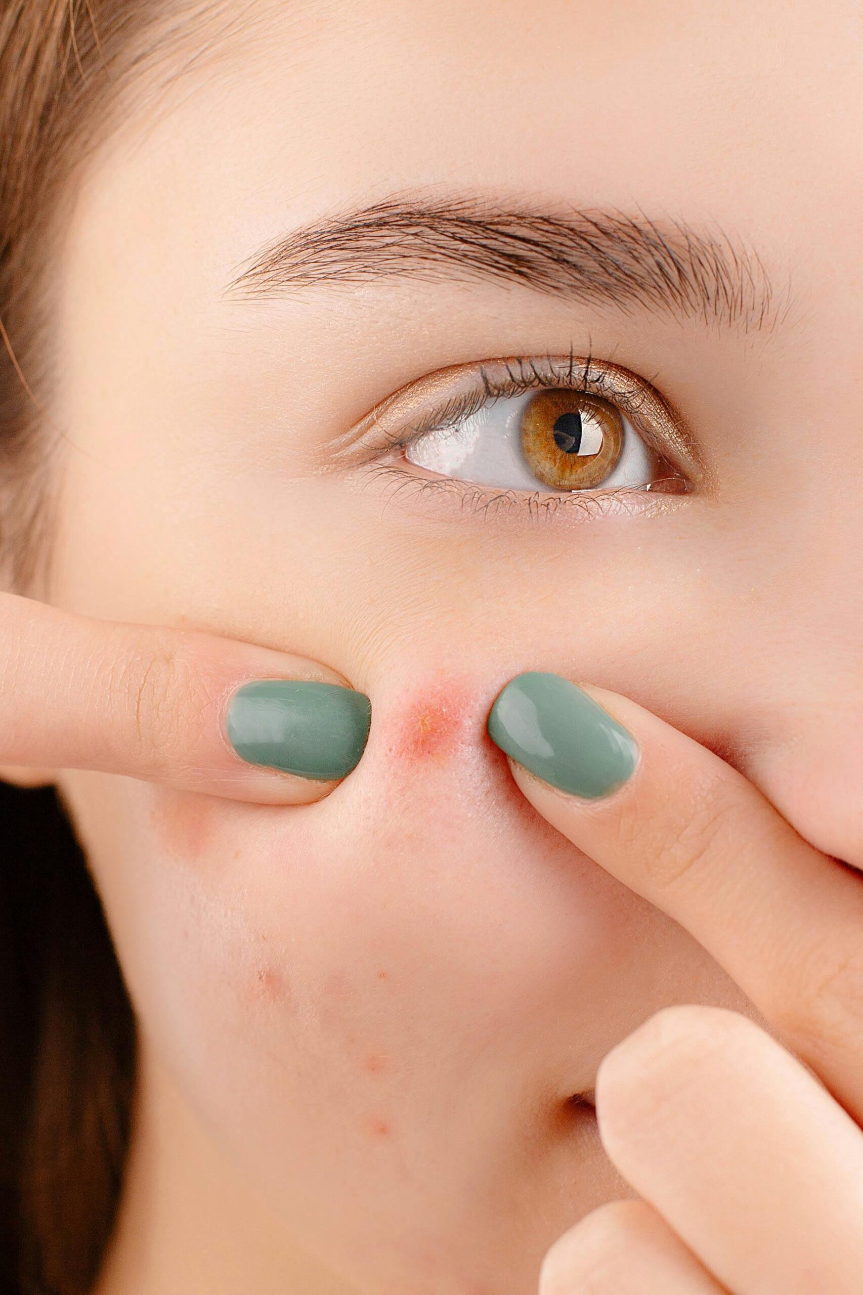 a young girl struggling with acne on her face