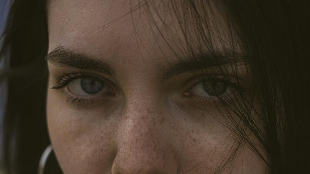 young lady with areas of hyperpigmentation on her face