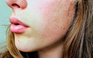 Read more about the article Your Complete Guide To Dry Skin (From Knowing What To Use And What To Avoid)